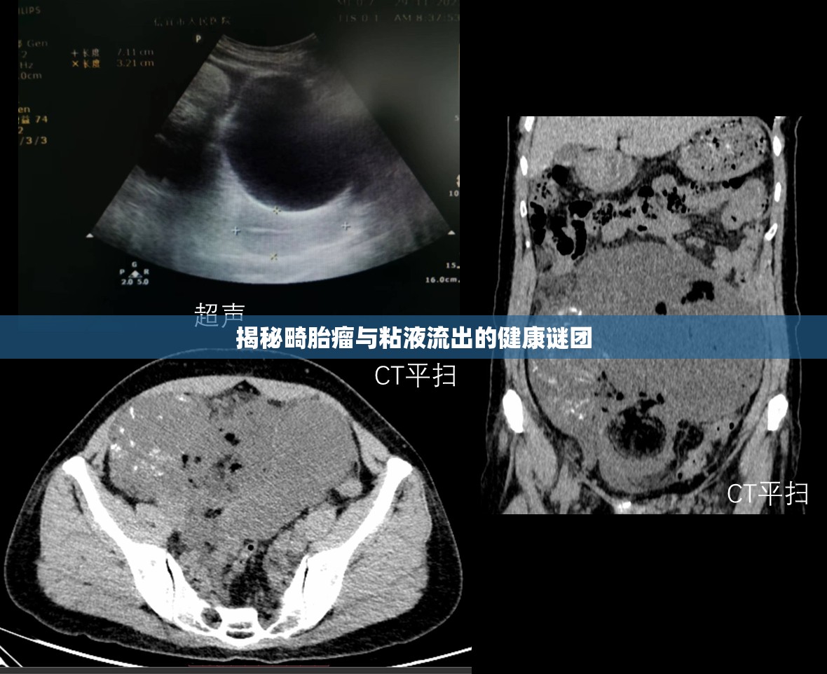 揭秘畸胎瘤與粘液流出的健康謎團(tuán)