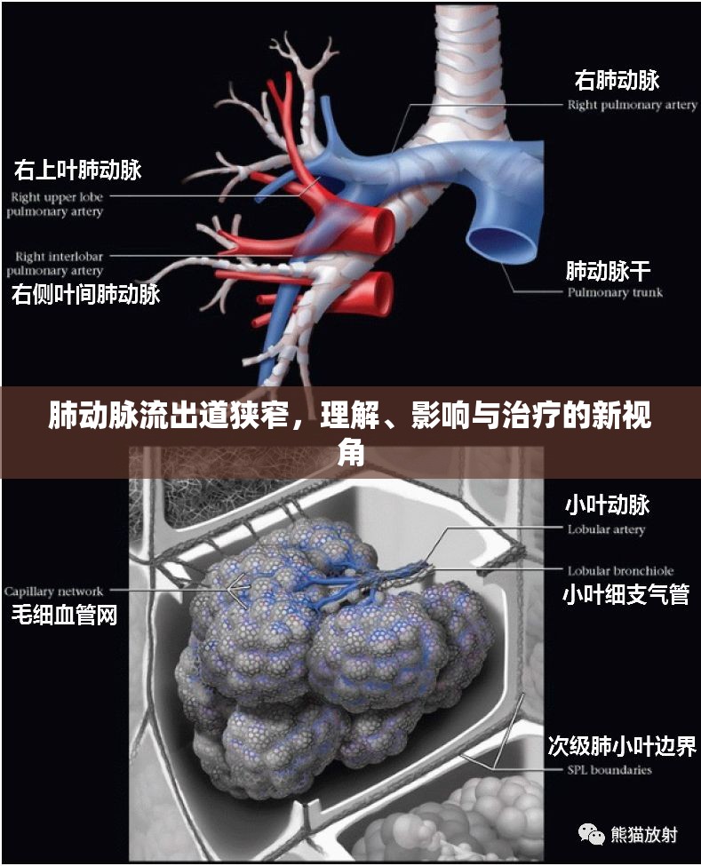 肺動脈流出道狹窄，理解、影響與治療的新視角