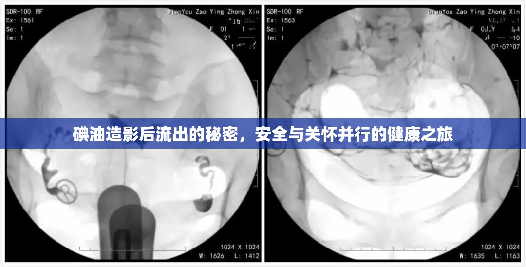 碘油造影后流出的秘密，安全與關(guān)懷并行的健康之旅