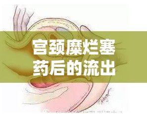 宮頸糜爛塞藥后的流出現(xiàn)象，理解、應(yīng)對與護(hù)理指南