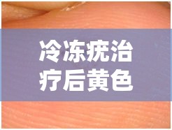 冷凍疣治療后黃色液體真相揭秘，了解那股黃色警報(bào)