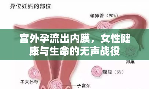 宮外孕流出內(nèi)膜，女性健康與生命的無聲戰(zhàn)役