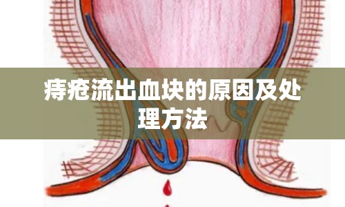 痔瘡流出血塊的原因及處理方法