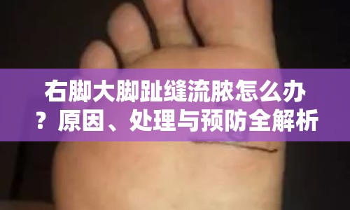 右腳大腳趾縫流膿怎么辦？原因、處理與預(yù)防全解析