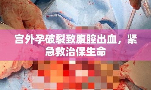 宮外孕破裂致腹腔出血，緊急救治保生命