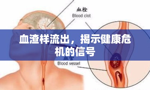 血渣樣流出，揭示健康危機(jī)的信號