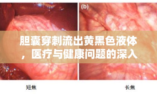 膽囊穿刺流出黃黑色液體，醫(yī)療與健康問題的深入探討