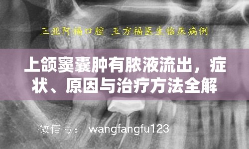 上頜竇囊腫有膿液流出，癥狀、原因與治療方法全解析