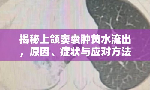 揭秘上頜竇囊腫黃水流出，原因、癥狀與應(yīng)對方法