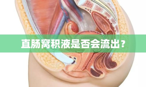 直腸窩積液是否會流出？