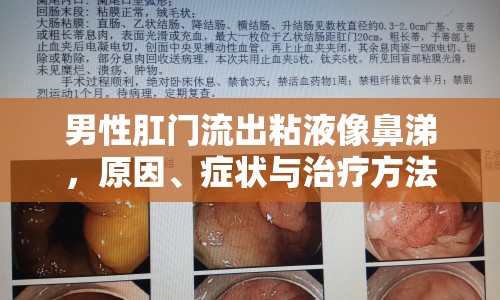 男性肛門流出粘液像鼻涕，原因、癥狀與治療方法全解析