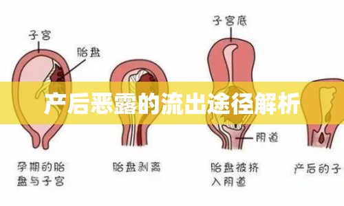 產(chǎn)后惡露的流出途徑解析