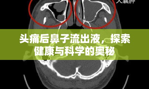 頭痛后鼻子流出液，探索健康與科學的奧秘