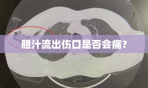 膽汁流出傷口是否會(huì)痛？