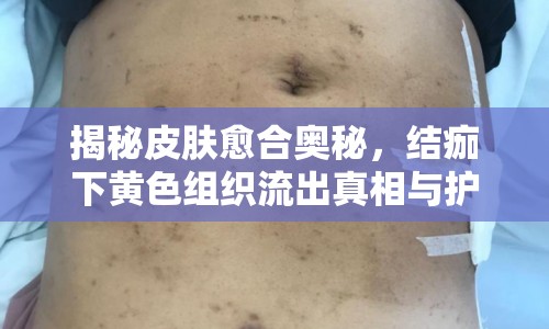 揭秘皮膚愈合奧秘，結(jié)痂下黃色組織流出真相與護(hù)理指南