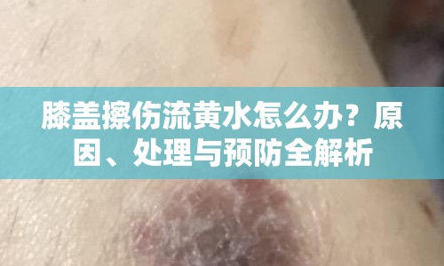 膝蓋擦傷流黃水怎么辦？原因、處理與預(yù)防全解析