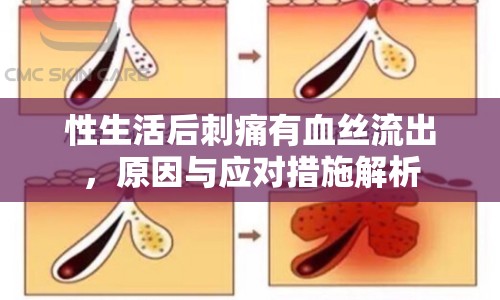 性生活后刺痛有血絲流出，原因與應對措施解析