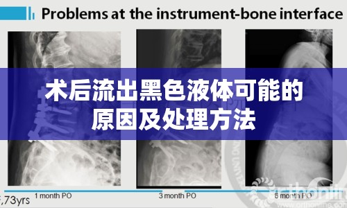 術(shù)后流出黑色液體可能的原因及處理方法