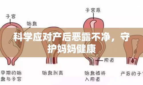 科學(xué)應(yīng)對產(chǎn)后惡露不凈，守護(hù)媽媽健康