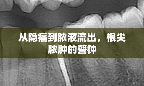 從隱痛到膿液流出，根尖膿腫的警鐘