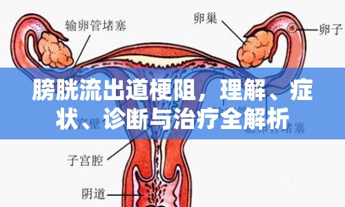 膀胱流出道梗阻，理解、癥狀、診斷與治療全解析