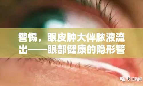 警惕，眼皮腫大伴膿液流出——眼部健康的隱形警鐘