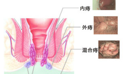 痔瘡有分泌物流出為什么？解析痔瘡癥狀及其原因