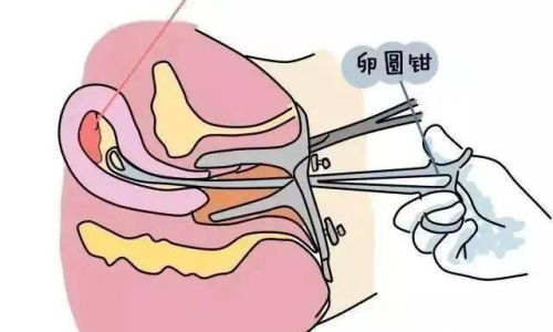 藥流會流出來，全面解析藥物流產(chǎn)的過程與注意事項(xiàng)